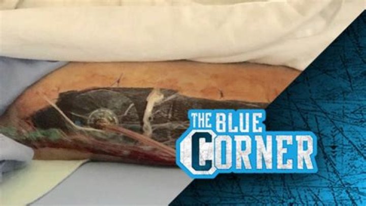 Unveiling The Secrets Of Austin Hubbard's Leg: Discoveries And Insights