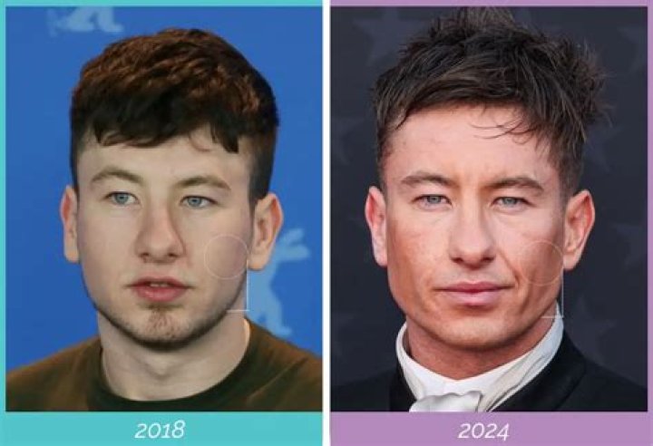 Unmasking Barry Keoghan's Eye Surgery: The Intriguing Details