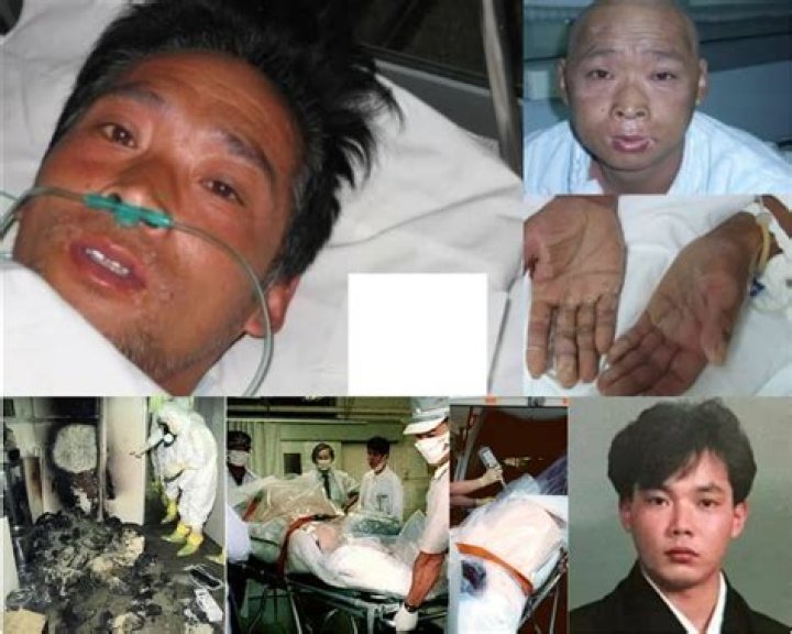 The Unbelievable Story Of The Man Who Defied Radiation: 83 Days Of Survival